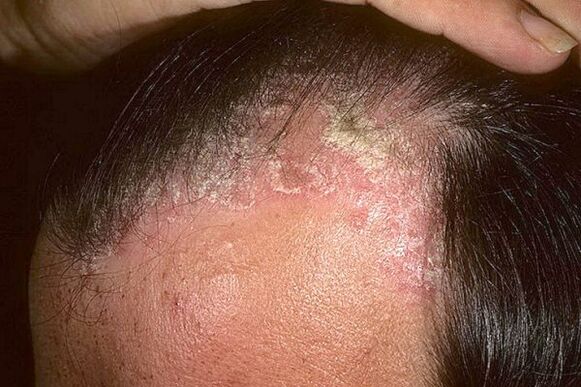 Psoriasis symptoms