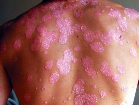 Psoriatic disease