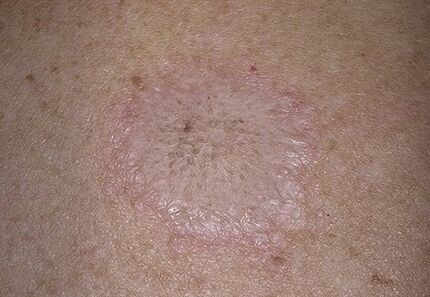 The phenomenon of the stearine stain