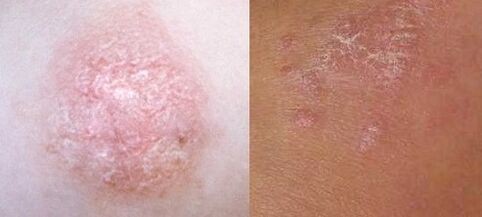 Psoriasis in the early stages